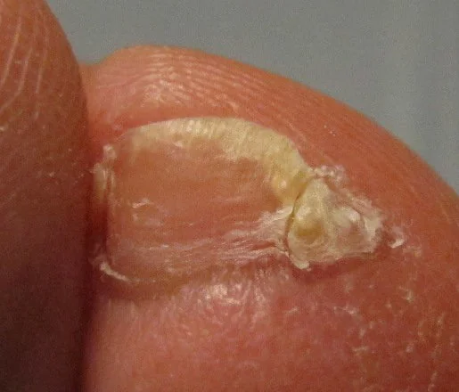 why is my pinky toenail split
