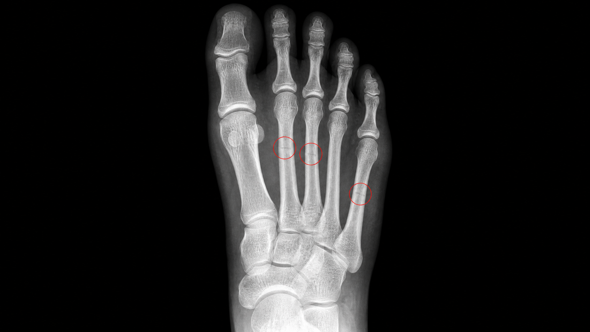2. Stress Fractures